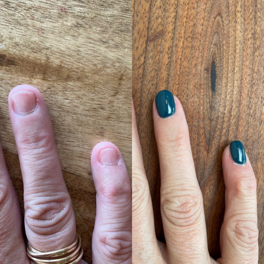 Before and after of bitten nails vs healthy gel manicure after quitting nail biting habit
